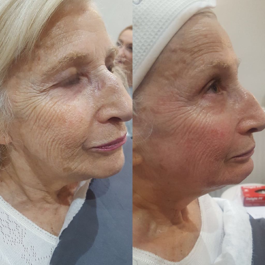 geneO before and after one session