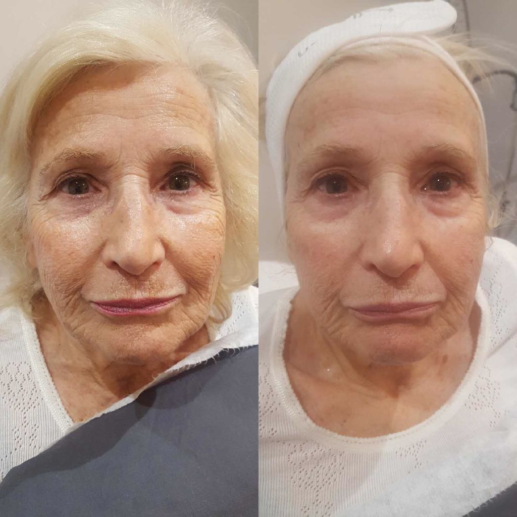 geneO before and after one session2